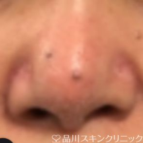症例NO.70718のBEFORE写真