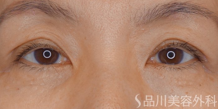 症例NO.72495のAFTER写真