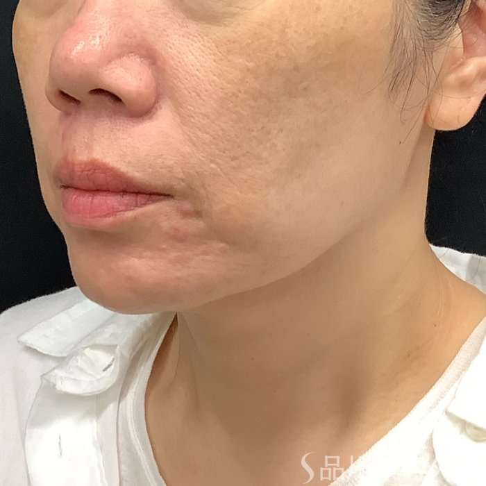 症例NO.75349のBEFORE写真