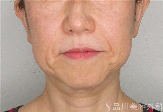 症例NO.56465のBEFORE写真