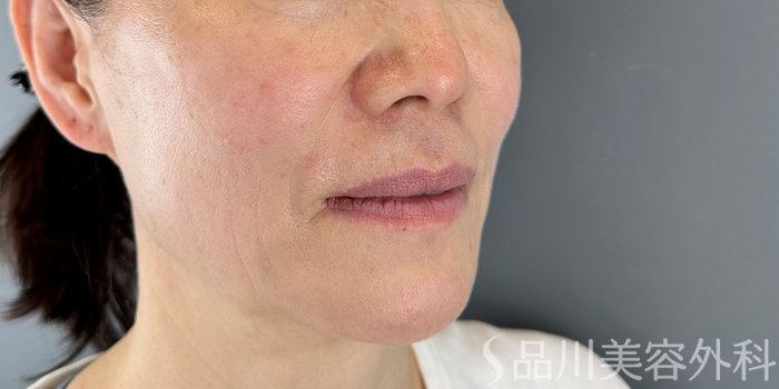 症例NO.70174のBEFORE写真