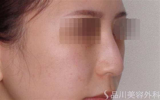 症例NO.48306のBEFORE写真