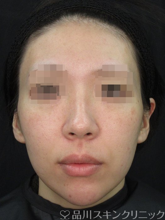 症例NO.73324のAFTER写真