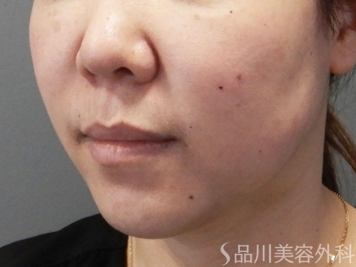 症例NO.70960のBEFORE写真