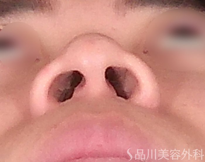 症例NO.69162のAFTER写真