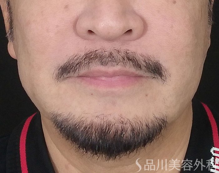 症例NO.67710のBEFORE写真