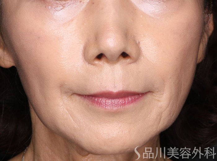 症例NO.72379のBEFORE写真