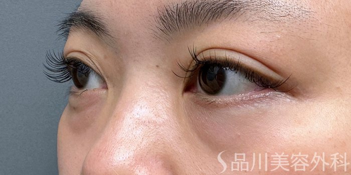 症例NO.74750のBEFORE写真