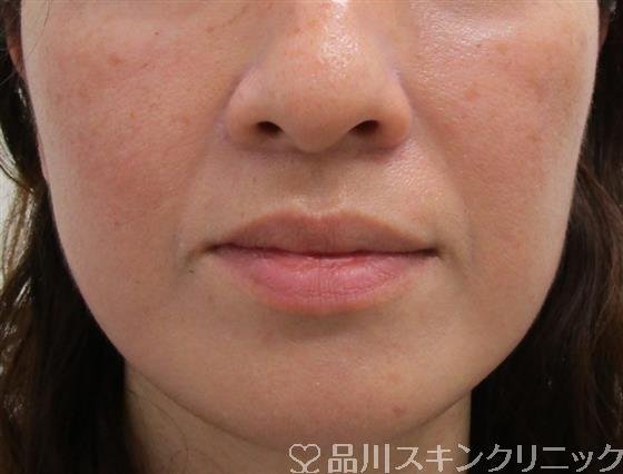 症例NO.38649のBEFORE写真