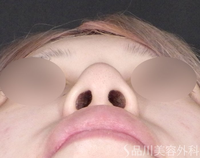 症例NO.72133のAFTER写真