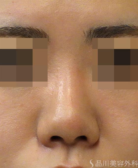 症例NO.39551のBEFORE写真
