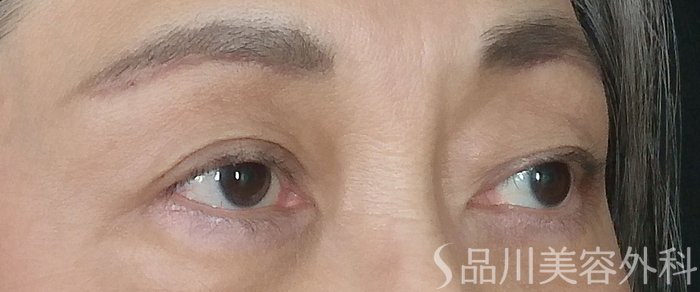症例NO.71564のAFTER写真