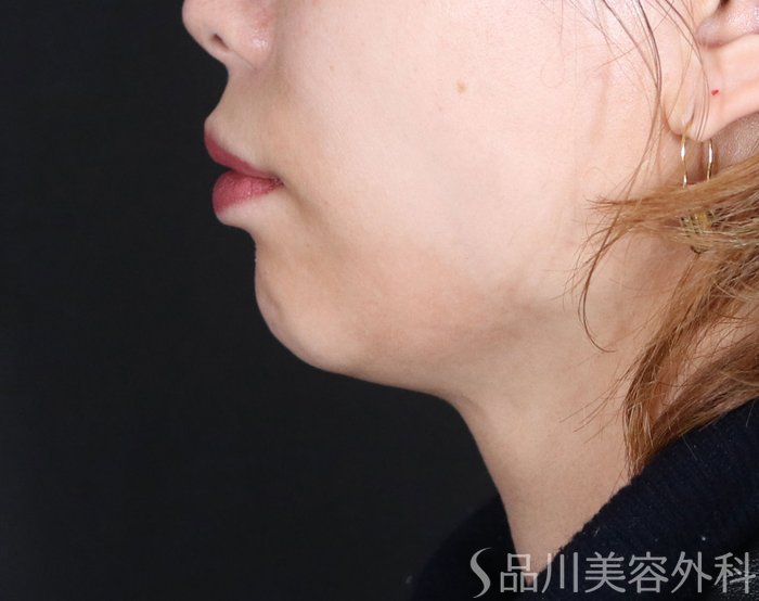 症例NO.72810のBEFORE写真