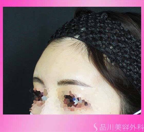 症例NO.53133のAFTER写真