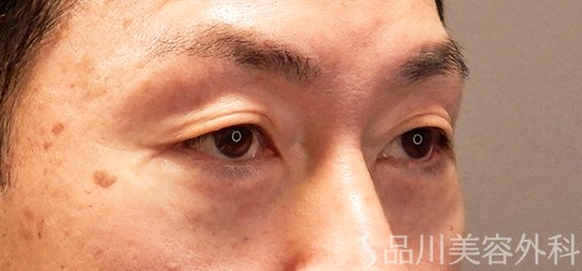 症例NO.70550のAFTER写真