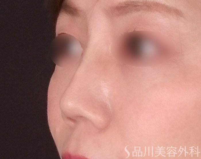 症例NO.69607のAFTER写真