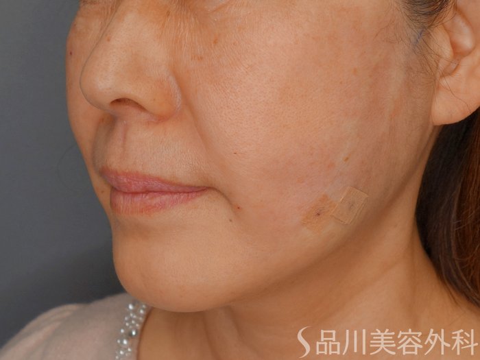 症例NO.73278のAFTER写真