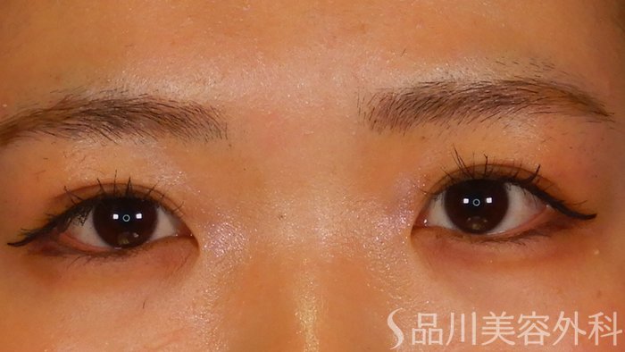 症例NO.67113のAFTER写真