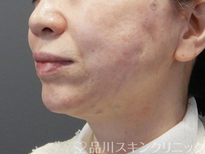 症例NO.73037のAFTER写真