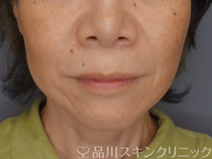 症例NO.71260のBEFORE写真