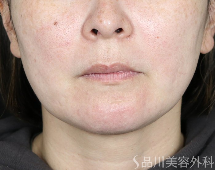 症例NO.73468のAFTER写真