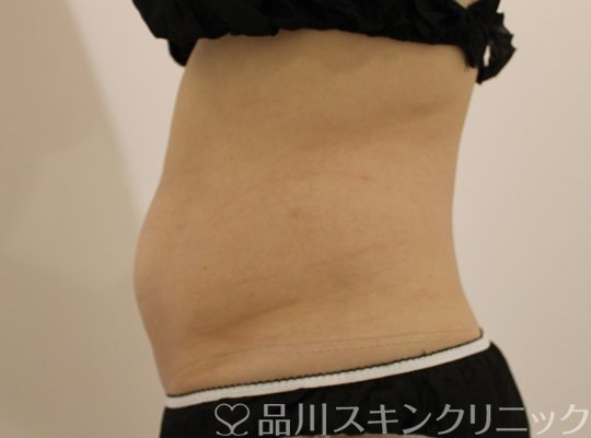 症例NO.75216のBEFORE写真