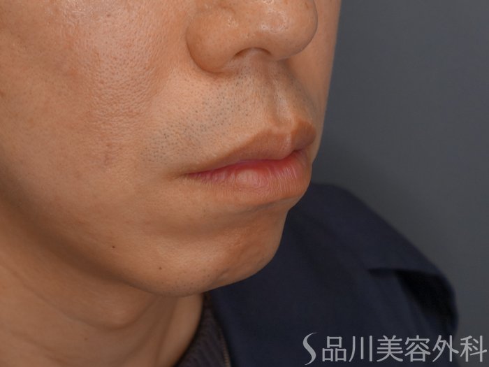 症例NO.69574のBEFORE写真