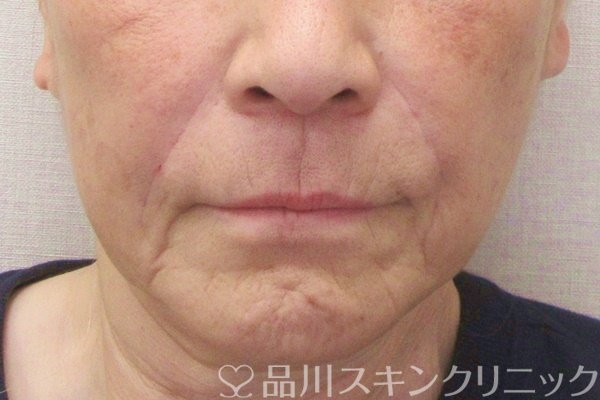 症例NO.70880のAFTER写真