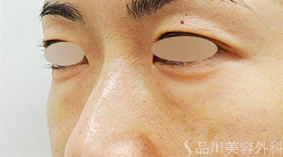 症例NO.49211のBEFORE写真