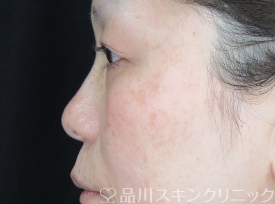 症例NO.69728のBEFORE写真