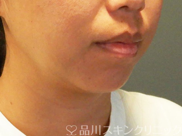 症例NO.66918のBEFORE写真