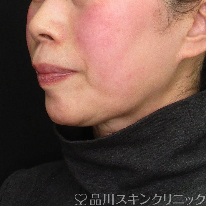 症例NO.69777のBEFORE写真