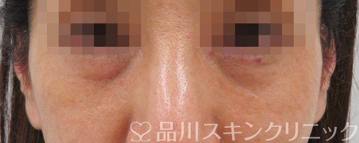 症例NO.63037のBEFORE写真