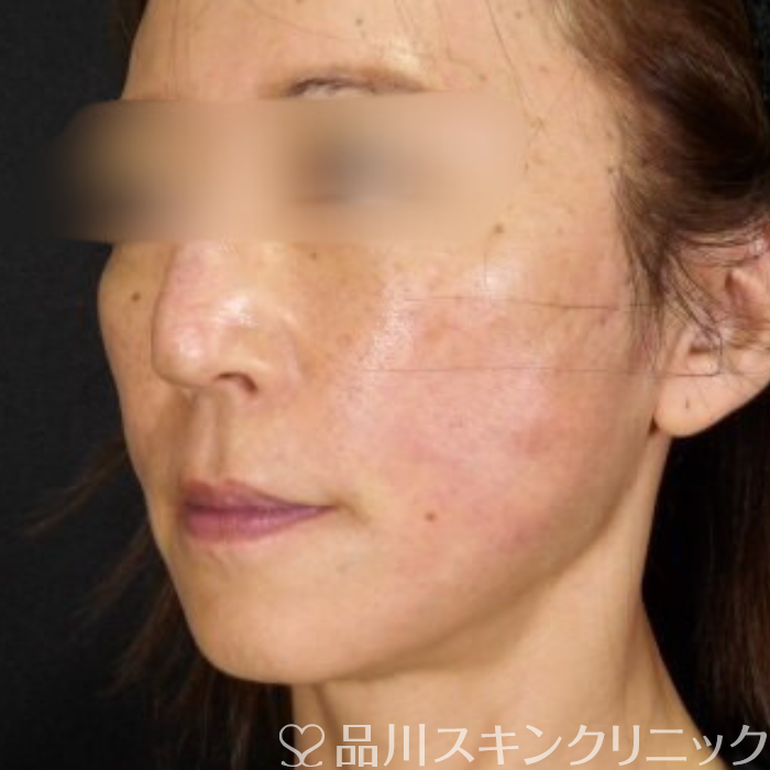症例NO.71213のAFTER写真