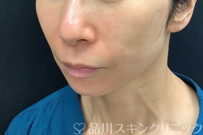症例NO.69840のAFTER写真