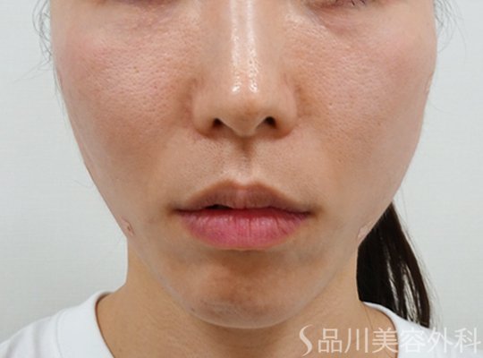 症例NO.72778のAFTER写真