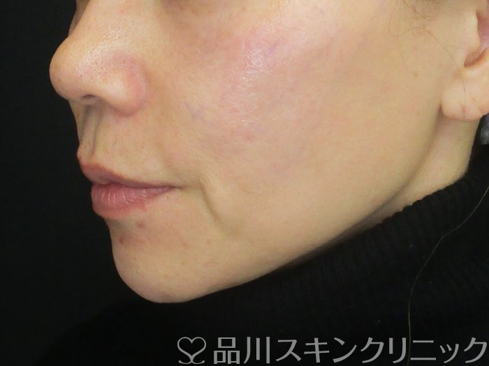 症例NO.72854のAFTER写真