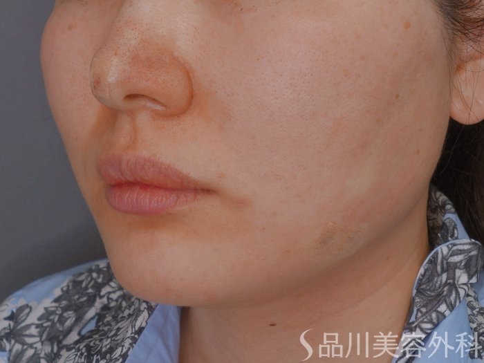 症例NO.73584のAFTER写真