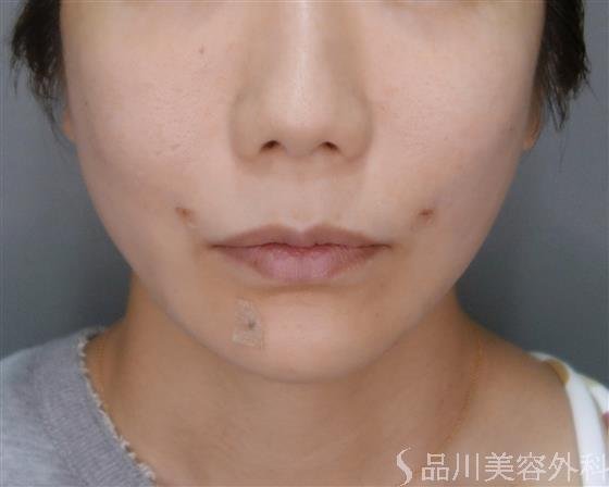 症例NO.51779のAFTER写真