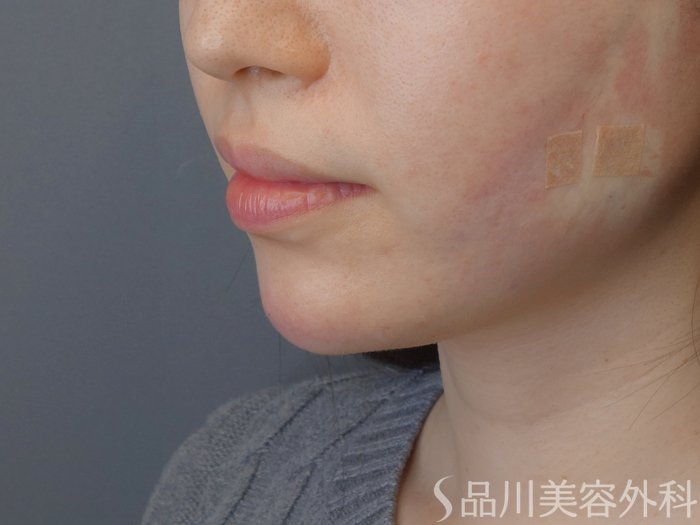 症例NO.72487のAFTER写真
