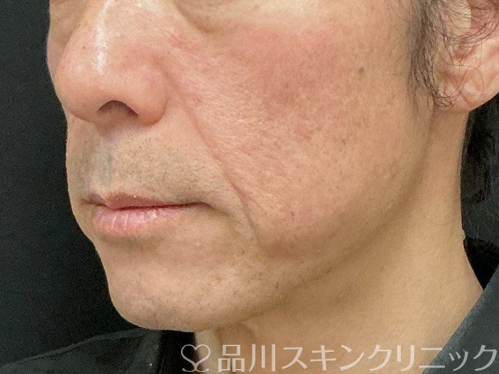 症例NO.74973のBEFORE写真
