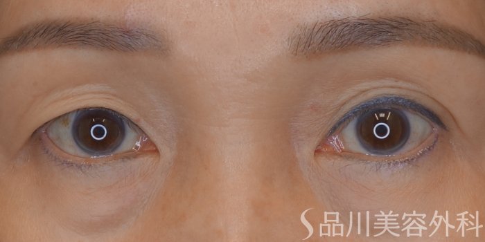 症例NO.68309のBEFORE写真