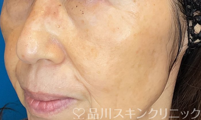 症例NO.74752のAFTER写真