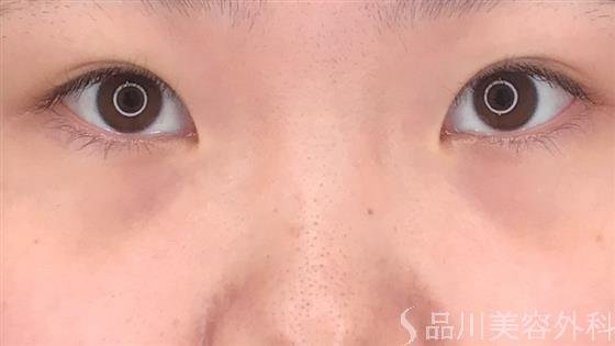 症例NO.55416のBEFORE写真