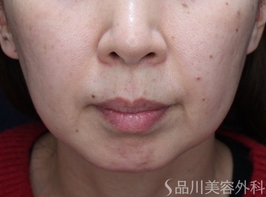 症例NO.73442のBEFORE写真