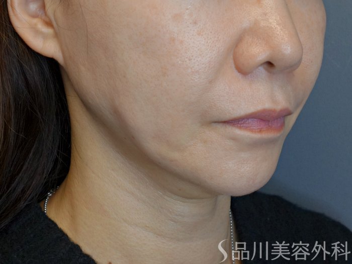 症例NO.72328のBEFORE写真