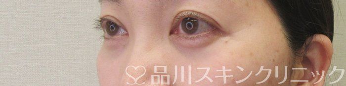 症例NO.69585のAFTER写真