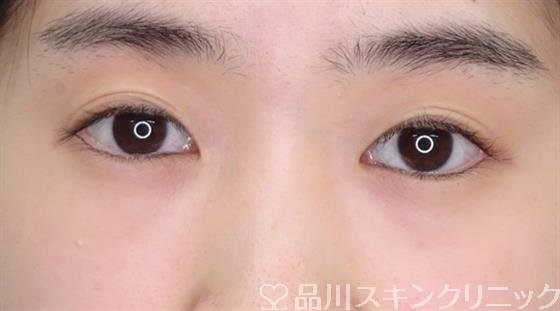 症例NO.60924のBEFORE写真