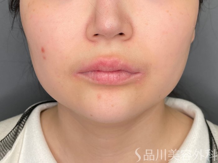 症例NO.70402のBEFORE写真