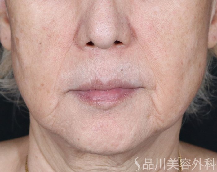 症例NO.71116のBEFORE写真